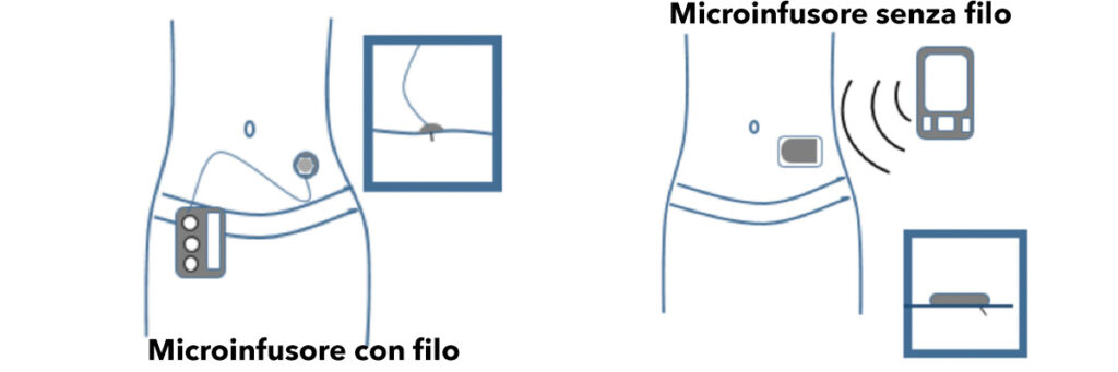 microinfusore